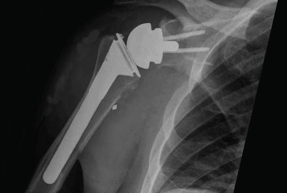 Post-operative x-ray of reverse shoulder replacement surgery